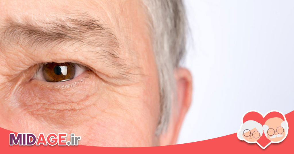 آب مروارید در سالمندی چیست و چه علائمی دارد؟