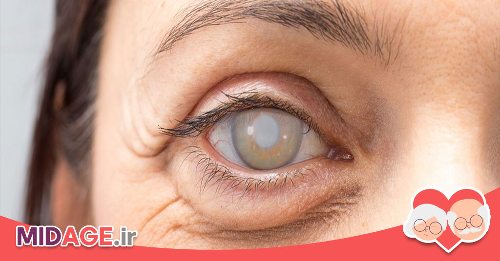 همه چیز در مورد آب مروارید، علائم این بیماری چیست و چگونه درمان می شود؟