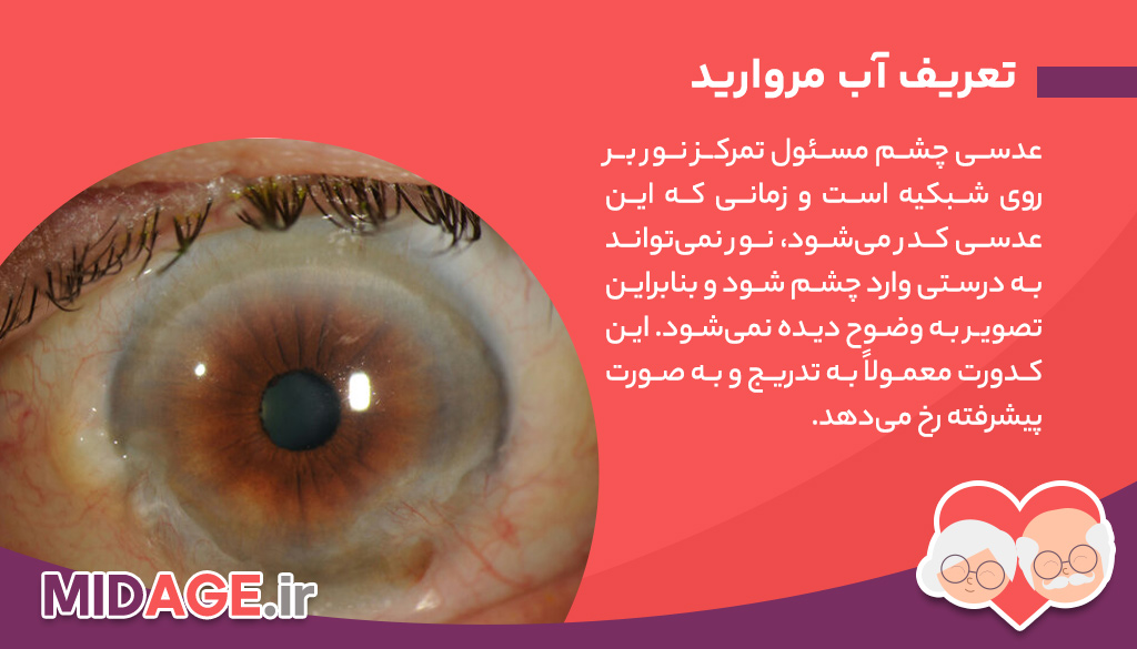 همه چیز در مورد آب مروارید، علائم این بیماری چیست و چگونه درمان می شود؟