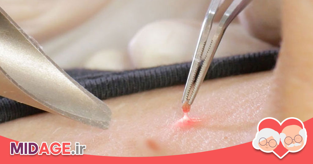 زگیل تناسلی مقعدی: علل، علائم، درمان و پیشگیری زگیل تناسلی مقعدی: علل، علائم، درمان و پیشگیری