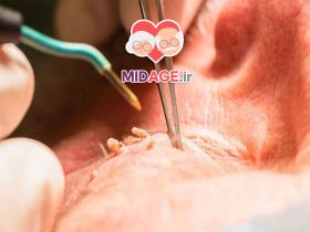 زگیل تناسلی مقعدی: علل، علائم، درمان و پیشگیری زگیل تناسلی مقعدی: علل، علائم، درمان و پیشگیری