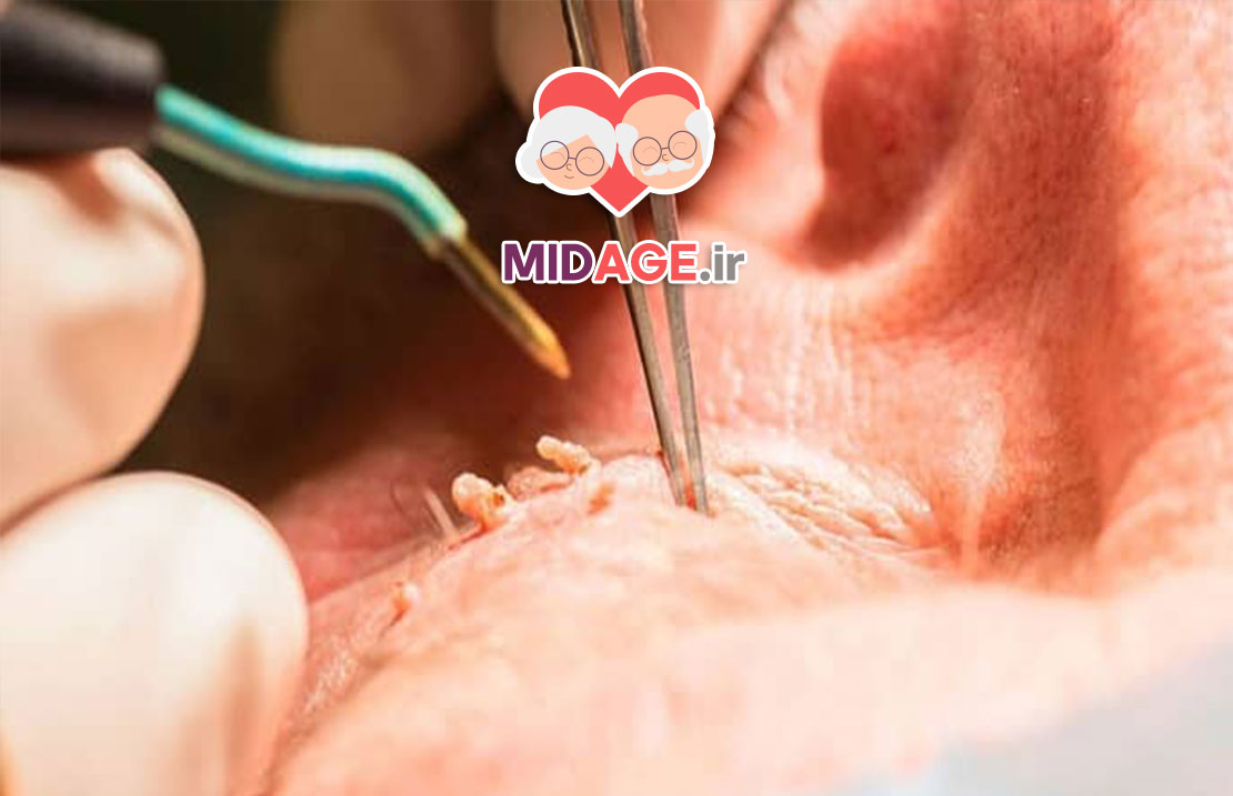 زگیل تناسلی مقعدی: علل، علائم، درمان و پیشگیری زگیل تناسلی مقعدی: علل، علائم، درمان و پیشگیری