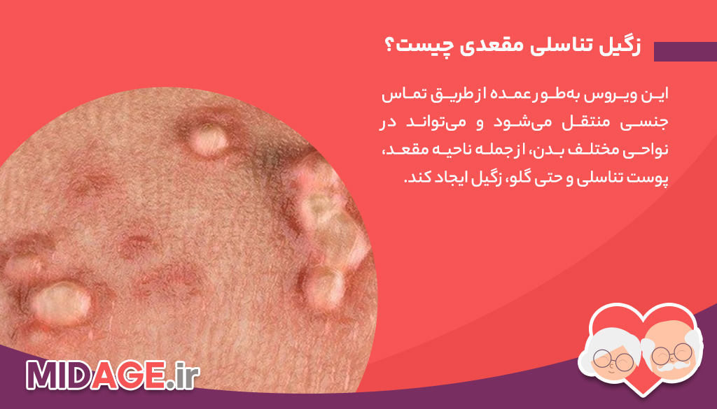 زگیل تناسلی مقعدی: علل، علائم، درمان و پیشگیری زگیل تناسلی مقعدی: علل، علائم، درمان و پیشگیری