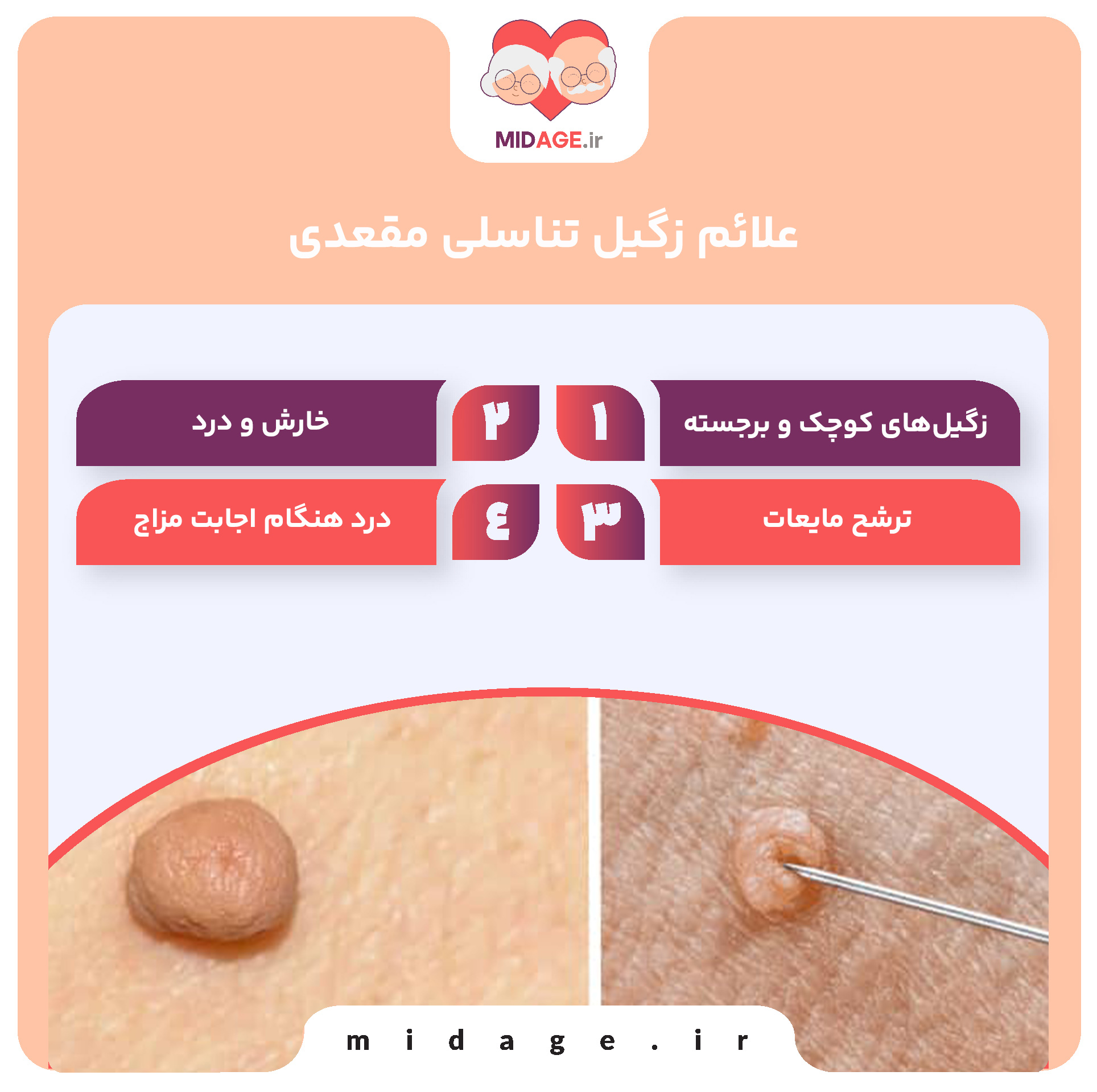 زگیل تناسلی مقعدی: علل، علائم، درمان و پیشگیری زگیل تناسلی مقعدی: علل، علائم، درمان و پیشگیری