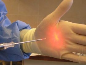 لیزر هموروئید؛ درمانی قطعی و فوری