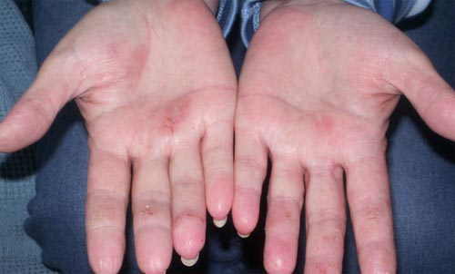 نگذاشتم انگشتانش را قطع کنند! دکتر زخم در کرج کلینیک زخم البرز