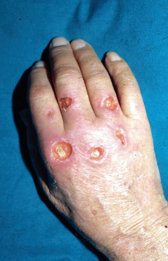 نگذاشتم انگشتانش را قطع کنند! Atypical Wounds and Wounds Resulting from Infection | SpringerLink