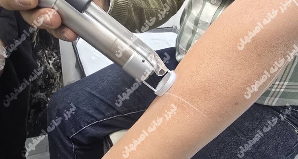 لیزر ارزان و با تخفیف در اصفهان