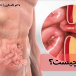 فتق چیست و چگونه به وجود می‌آید؟ | راهنمای کامل علائم، علت و درمان فتق