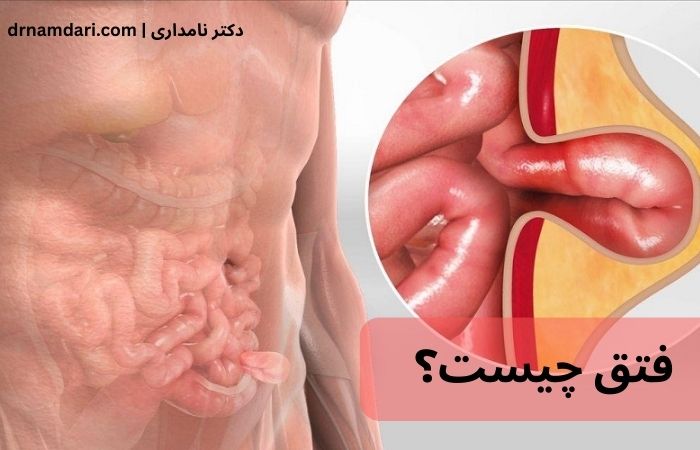فتق چیست و چگونه به وجود می‌آید؟ | راهنمای کامل علائم، علت و درمان فتق