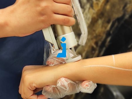 لیزر موهای زائد در دوران بلوغ، بارداری و یائسگی | بایدها و نبایدها