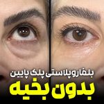 دکتر بلفاروپلاستی