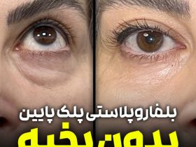 بلفاروپلاستی، راز زیبایی صورت و چشمها در میانسالی دکتر بلفاروپلاستی