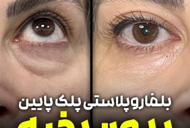 دکتر بلفاروپلاستی