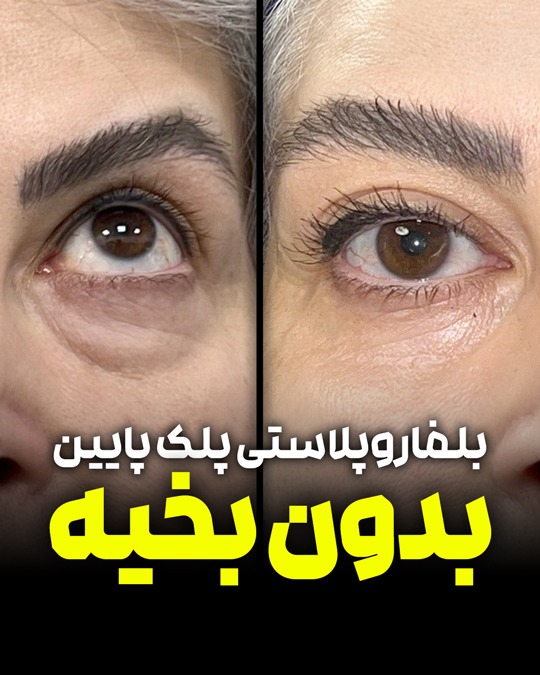 دکتر بلفاروپلاستی